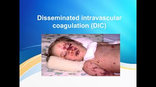 Disseminated intravascular coagulation DIC [upl. by Repotsirhc]