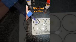 Serological practical WIDAL test typhoidfever trending practical pathology shorts [upl. by Alyce]