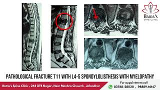 Osteoporotic Spinal Fracture Fixation And Biopsy  LifeChanging Spine Surgery Success Story 14 [upl. by Akissej]