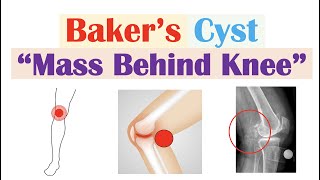 Baker Cyst Popliteal Cyst  Why They Occur Symptoms Diagnosis Treatment [upl. by Rutan]