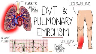 Deep Vein Thrombosis DVT amp Pulmonary Embolism Explained [upl. by Ynnej645]