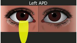 Relative Afferent Pupillary Defect  Medical Student Education [upl. by Nnek]