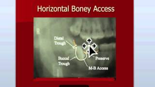 Oral Surgery Hints  Impactions Continued [upl. by Larner916]