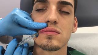 Restylane Defyne lip filler treatment in a male patient by Dr Shaun Patel [upl. by Chretien]