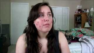 Accutane Birth defects [upl. by Aicetel]