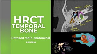 HRCT TEMPORAL BONE Illustrations and detailed radioanatomy on HRCT FACIAL NERVE on HRCT T BONE [upl. by Sivat]