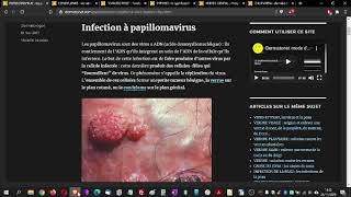 PAPILLOMAVIRUS  le papilloma virus ou HPV symptomes que faire [upl. by Esirehc440]