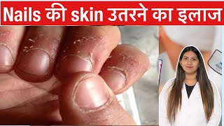 Nail Skin Peeling  नाखून की खाल उतरना  Hangnails Treatment  Finger skin peeling treatment [upl. by Rollecnahc952]