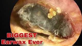 Removes BIGGEST Earwax on both sides EP7  Doctor Anh [upl. by Iorio941]