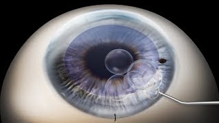 DMEK Descemets membrane endothelial keratoplasty animation [upl. by Celio]