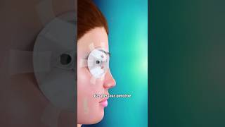 Como É Realizada A Cirurgia de Miopia LASIK 👁️ [upl. by Ayyn]