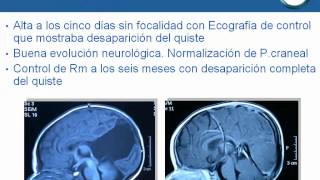 NeurorgsnetQuiste intracerebral en lactante [upl. by Karee]