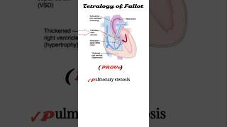 tetralogy of fallot mnemonic  TOF [upl. by Etnwahs]