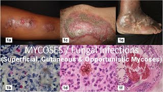 Mycoses  Fungal Infections  Superficial Cutaneous amp Opportunistic Mycoses  Microbiology Lecture [upl. by Annoirb]