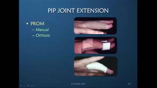 Obstinate PIP Joint Part 6 of 12 Regaining PIP Joint Extension [upl. by Ahsenhoj155]