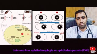 Internuclear ophthalmoplegia INO Neurophysiology and Neuroanatomyophthalmology medicalhindi [upl. by Mervin]