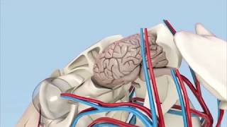 Animation to show the changes in the pituitary gland in Equine Cushings disease [upl. by Hattie]