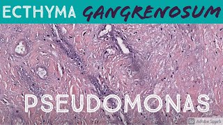 Ecthyma Gangrenosum Pseudomonas aeruginosa 5Minute Pathology Pearls Dermatology Dermatopathology [upl. by Gildea]