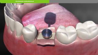 Biotech Dental Protocole chirurgical de pose dun implant dentaire KONTACT souscrestal [upl. by Anitsud]