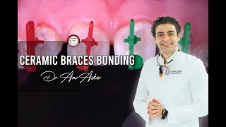 Step by step ceramic braces bonding Dentaurum by Dr amr Asker [upl. by Eerrehs]