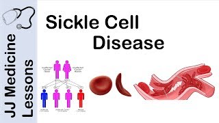 Sickle Cell Disease  Pathophysiology Symptoms and Treatment [upl. by Ydoc387]