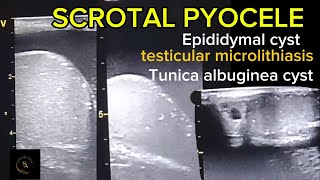 Complex hydroceleScrotal pyocele epididymal cyst testicular microlithiasis Tunica albuginea cyst [upl. by Arrotal]