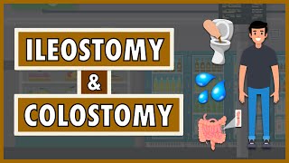 Ileostomy and Colostomy  Emphasis on DietNutrition [upl. by Day]