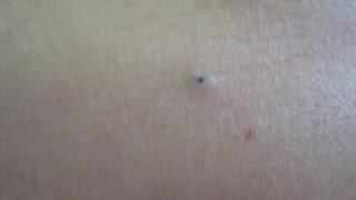 Dilated Pore Treatment [upl. by Addy]