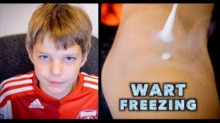 FREEZING A BIG WART OFF A KNEE WITH LIQUID NITROGEN kid does not even blink  Dr Paul [upl. by Ettolrahs975]