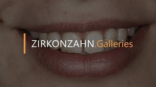 Prettau® veneers with PlaneSystem® and Face Hunter  ZirkonzahnGalleries [upl. by Damali]