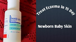 Desonide Lotion Treat Eczema in 15 Days for Newborn BabyToddler [upl. by Hiro378]