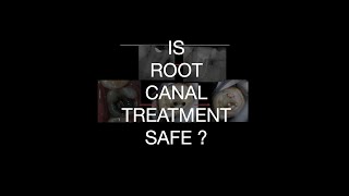 Clearing myths about ROOT CANAL TREATMENT [upl. by Cleon]