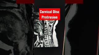 Cervical Foraminal Disc Protrusion of C56 level [upl. by Roberts]