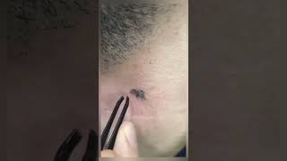 ingrown hair removal 😌 ENJOY [upl. by Adeys]