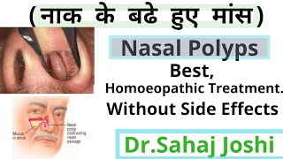 Homoeopathic Medicine For Nasal Polypsनाक के बढे हुए मांस [upl. by Darcia294]