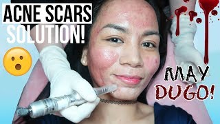 Flawless MICRO NEEDLING TREATMENT for ACNE SCARS Sugugatin Para Gumaling [upl. by Darlleen]