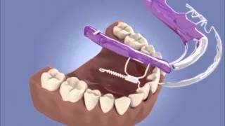 How Does Inman aligner braces work to straighten up teeth [upl. by Maxi898]