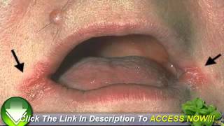 Cold Sores in the Corner of the Mouth  Have You Got Angular Cheilitis [upl. by Almeeta]