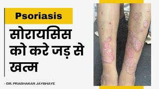 सोरायसिस को करे जड़ से खत्म  Psoriasis complete cure psoriasis skin itching scalp treatment [upl. by Mendie]