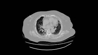 honeycomb lung [upl. by Bullis]