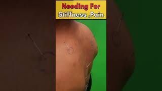 कमर दर्द ✅ गर्दन दर्द  dry needling for back pain backpain neckpain shorts health hindi [upl. by Sabec]