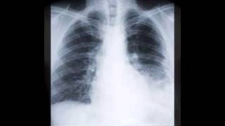 asbestos mesothelioma xray slide [upl. by Diver]