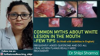 मुंह में सफेद दाग। WHITE LESION IN THE MOUTH COMMON MYTHS amp FEW TIPS [upl. by Calvin]