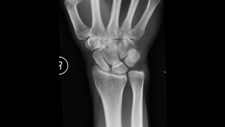 TFCC TEAR REPAIR ULNAR OSTEOTOMY SURGERY FINAL OUTCOME [upl. by Wertz21]