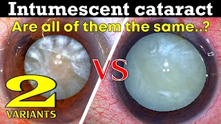 Intumescent Cataracts Are all of them the same  Dr Deepak Megur [upl. by Drue]