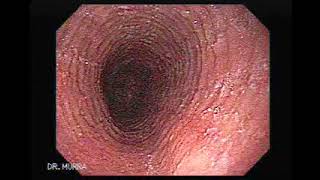 Esofagitis Eosinofilica [upl. by Brennan744]