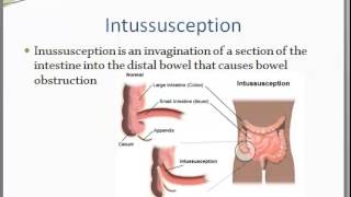 Intussusception and Volvulus [upl. by Cirdet]