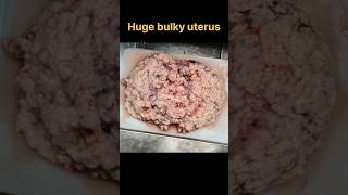 Huge fibroid uterus with secondary changes specimen for histopathology  histopathology [upl. by Aikemehs449]