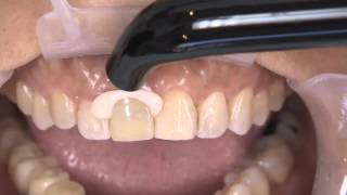 How to Complete an Anterior Dental Restoration with Kerrs Nexus RMGI [upl. by Retsehc131]