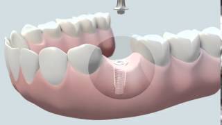 Cómo se coloca un implante dental [upl. by Piers64]